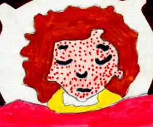 Illustration de l'article Que faire en cas de varicelle ?