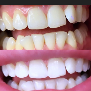 Microneedling bb glow